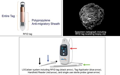 optional rfid tag insertion|rfid tag before breast cancer surgery.